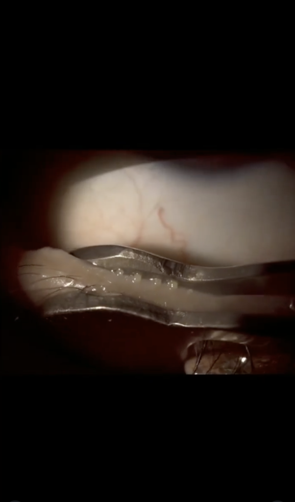 meibomian gland expression