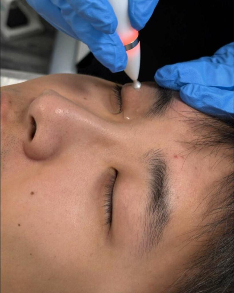 jett plasma treatment performed on patients eyelid