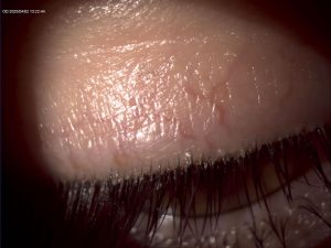 Blepharitis on Dr Madan patient