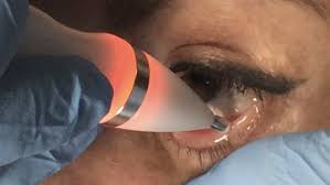 jett plasma treatment on inner eyelid to improve oil gland function