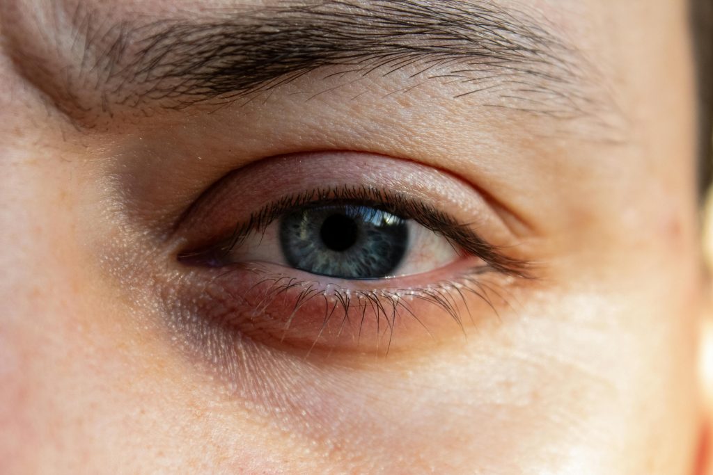 Close up of a person's eye with inflamed eyelids and mgd